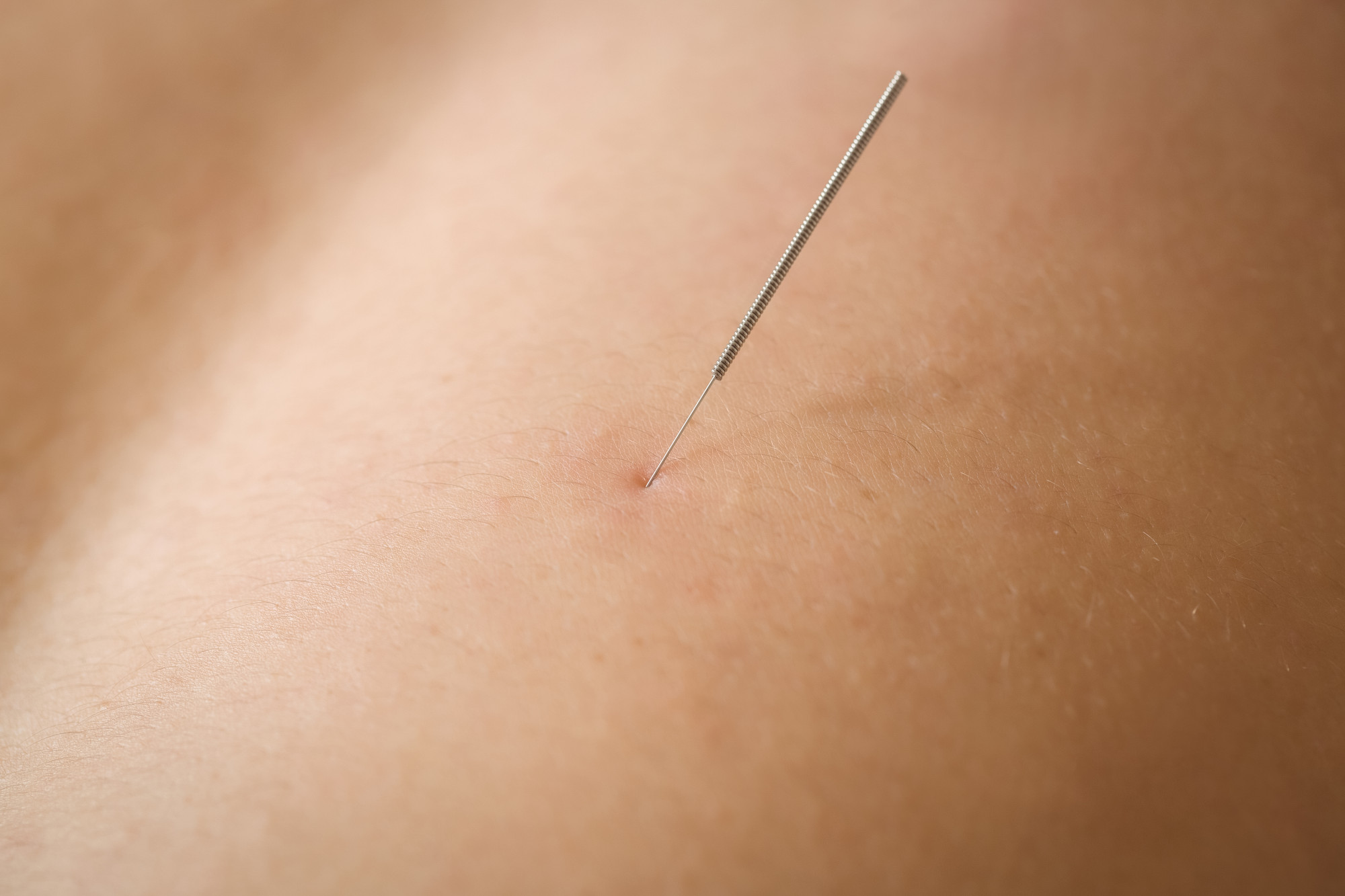 Dry Needling
